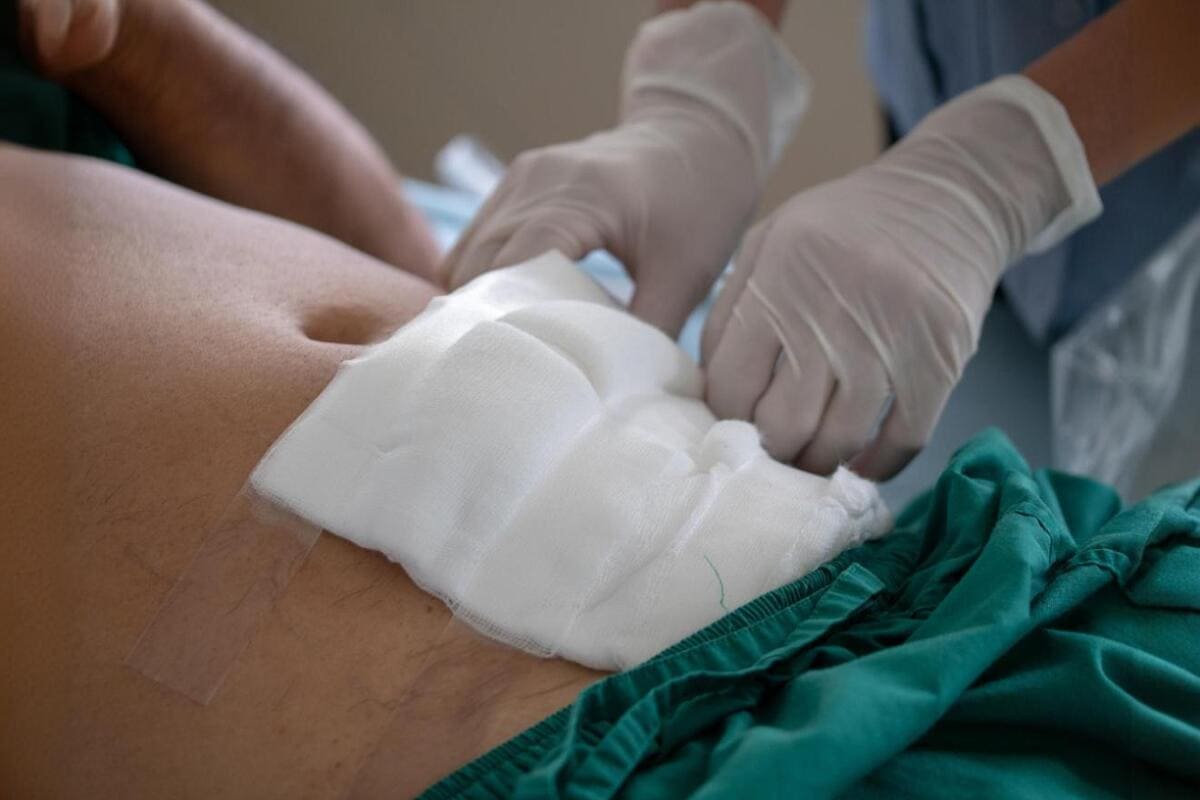 Cirugía de hernia umbilical